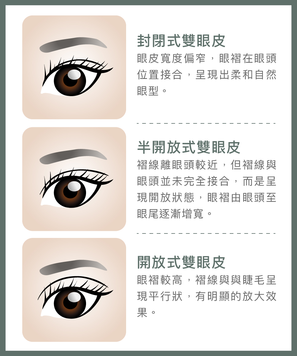 雙眼皮手術流程-客製化雙眼皮