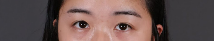 雙眼皮手術案例-術前