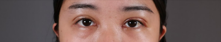 雙眼皮手術案例-術後一週