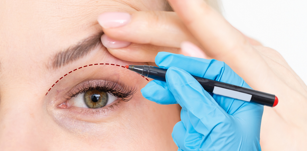 雙眼皮手術失敗怎麼辦？